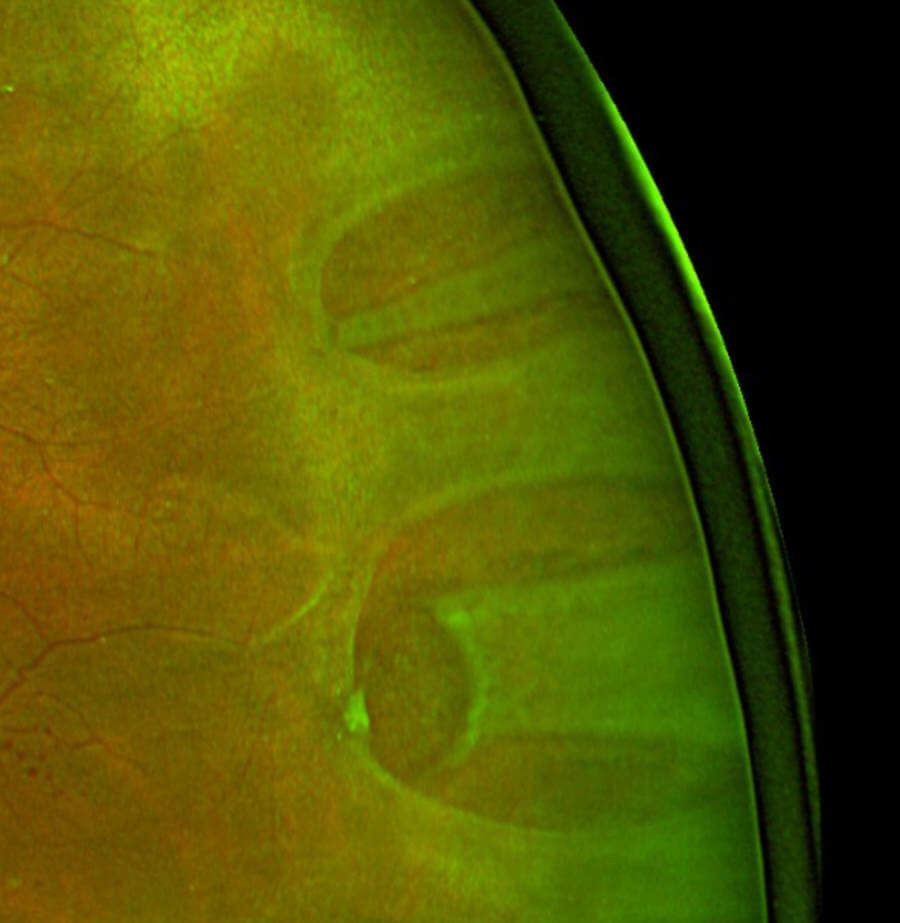 Imagem ilustrativa: Descolamento de Retina