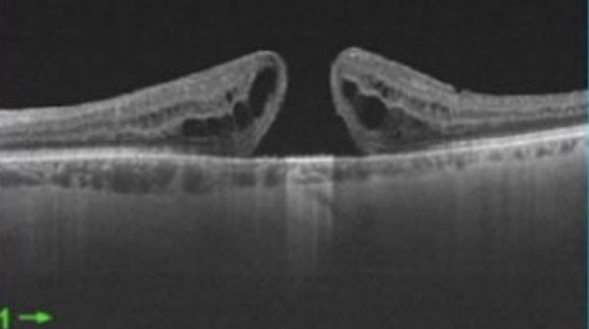 Imagem ilustrativa: Buraco Macular