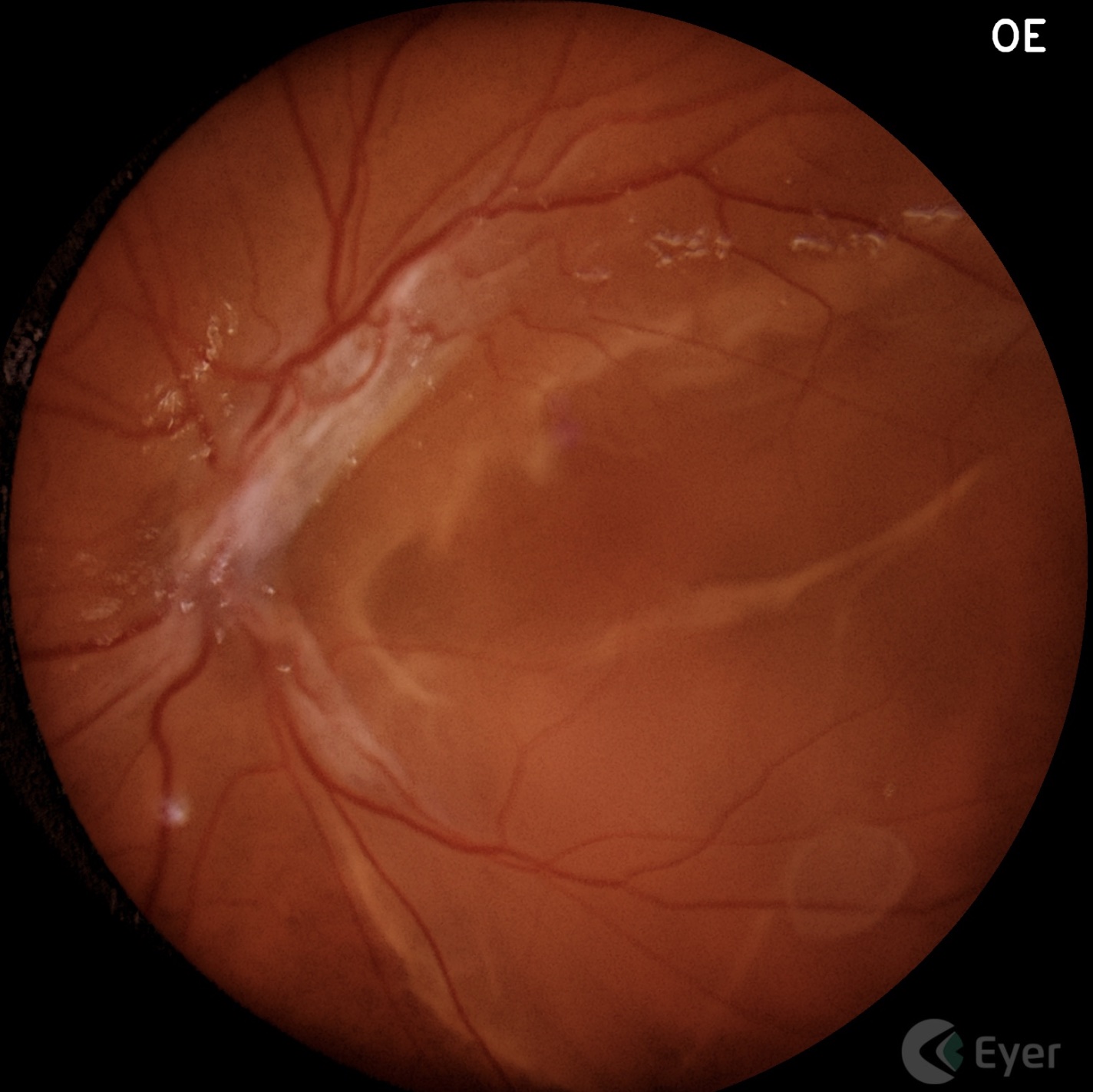 Imagem ilustrativa: Descolamento de Retina