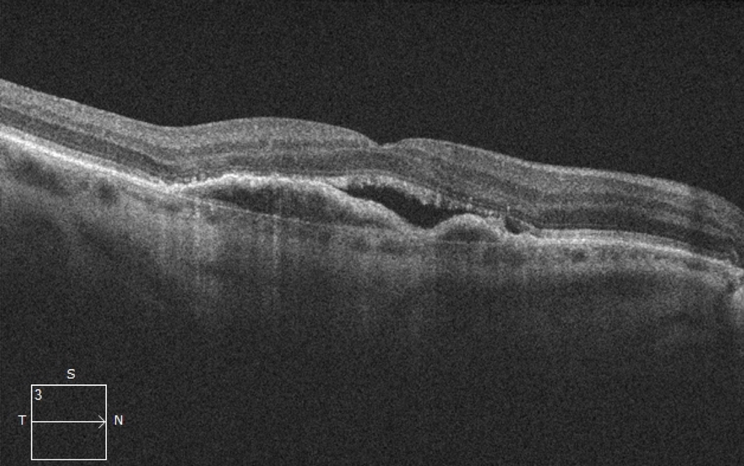 Imagem ilustrativa: Doença Macular Relacionada à Idade (DMRI)