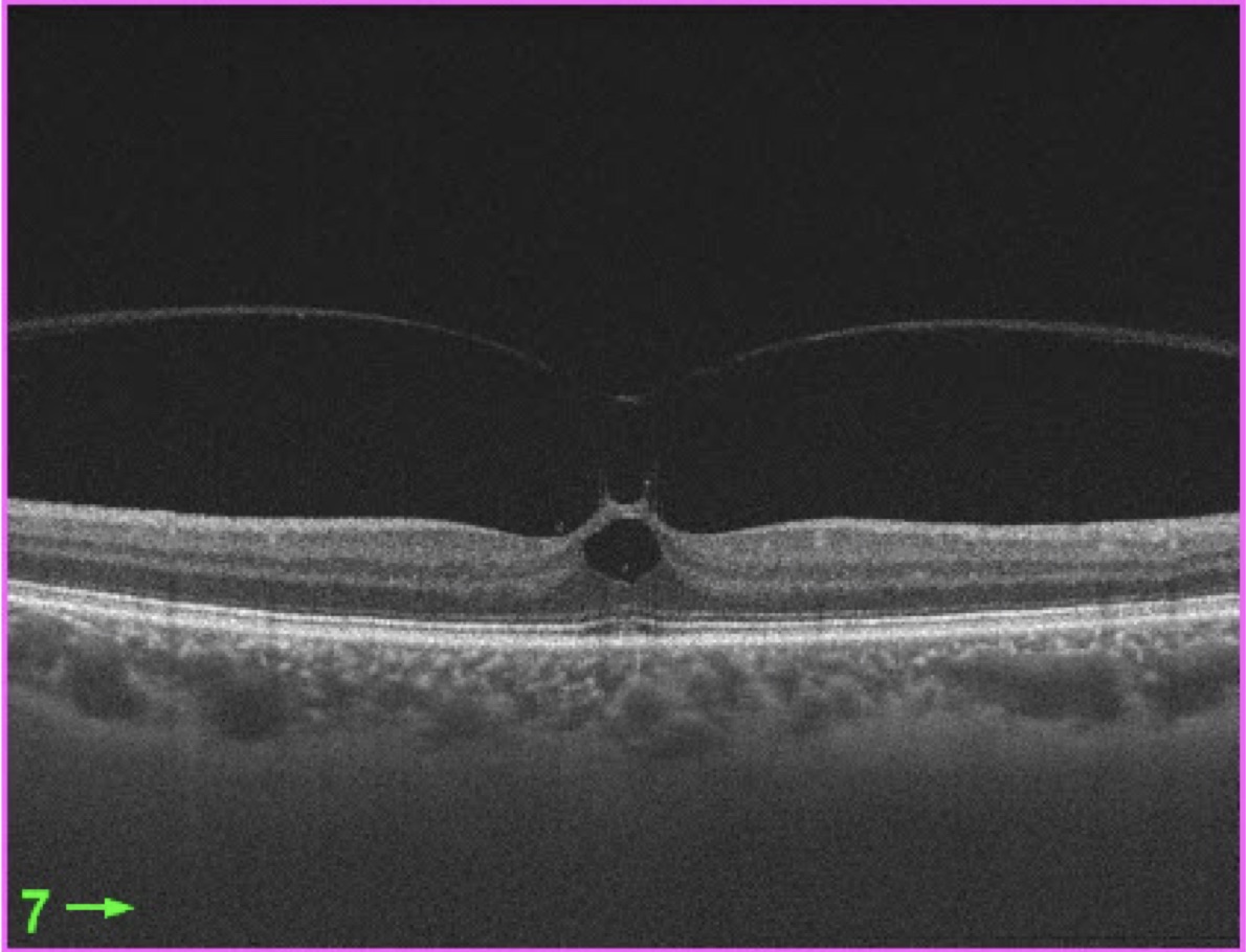 Imagem ilustrativa: Síndrome de Tração Vítreo-Macular