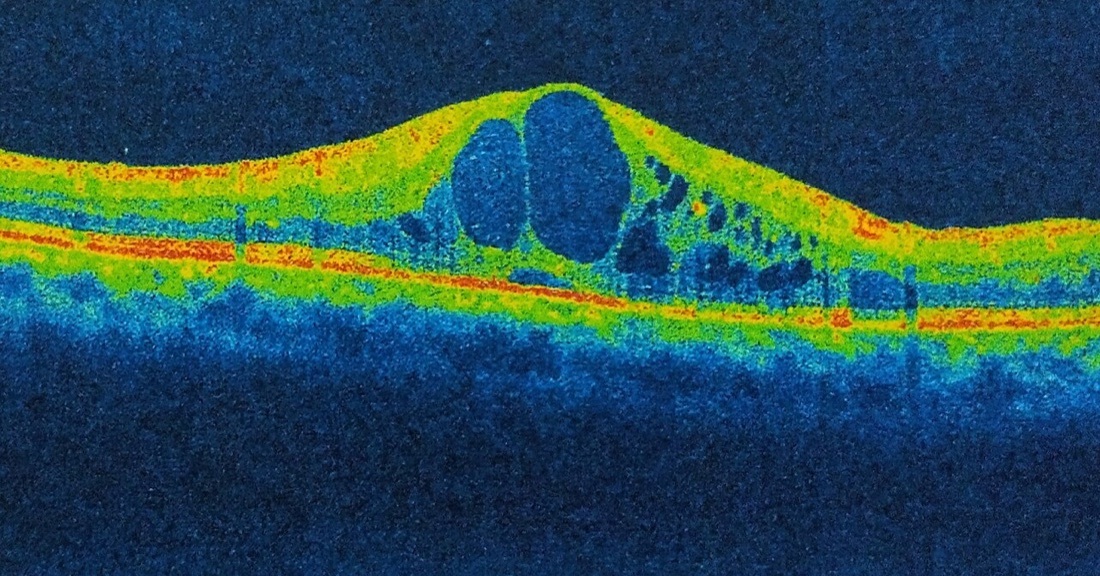Imagem ilustrativa: Edema Macular (Uveíte e Pós-Operatório)