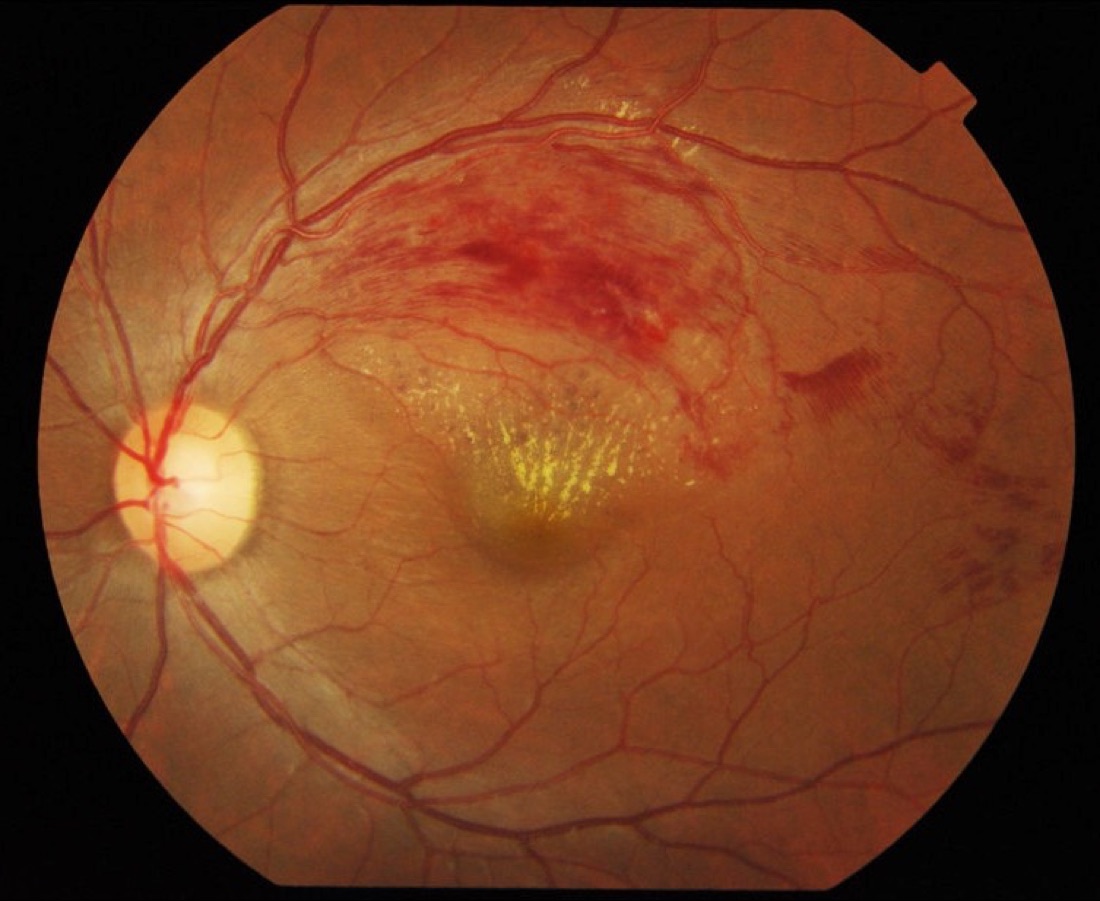 Imagem ilustrativa: Oclusões Vasculares da Retina