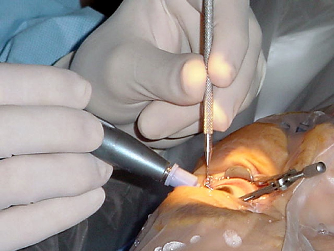 Imagem ilustrativa: Cirurgia de Catarata