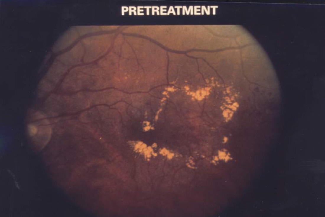 Imagem ilustrativa: Edema Macular Diabético
