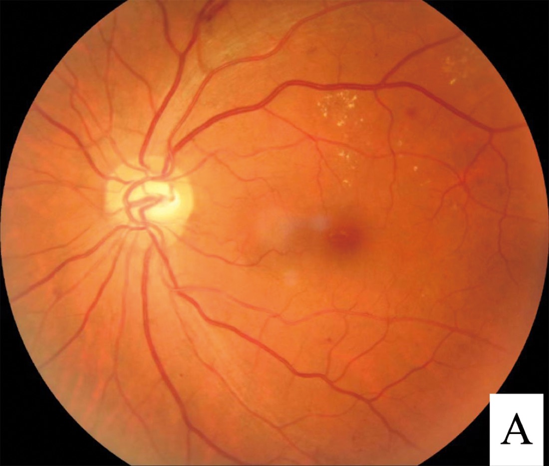 Imagem ilustrativa: Retinopatia Diabética Não Proliferativa