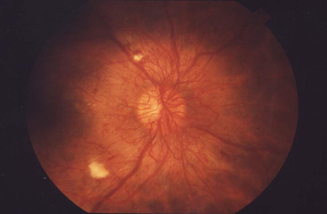 Imagem ilustrativa: Retinopatia Diabética Proliferativa